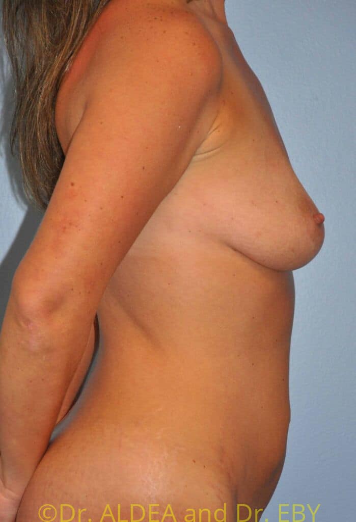 Before Image: Breast Augmentation w/ Lift #900 - right-side