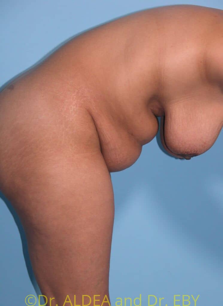 Before Image: Tummy Tuck #333 - other