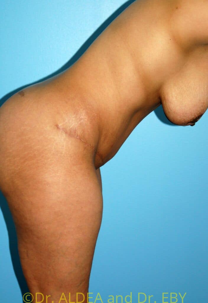 After Image: Tummy Tuck #333 - other