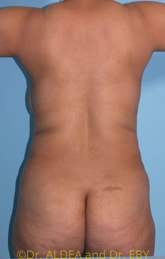 Before Image: Tummy Tuck #333 - back