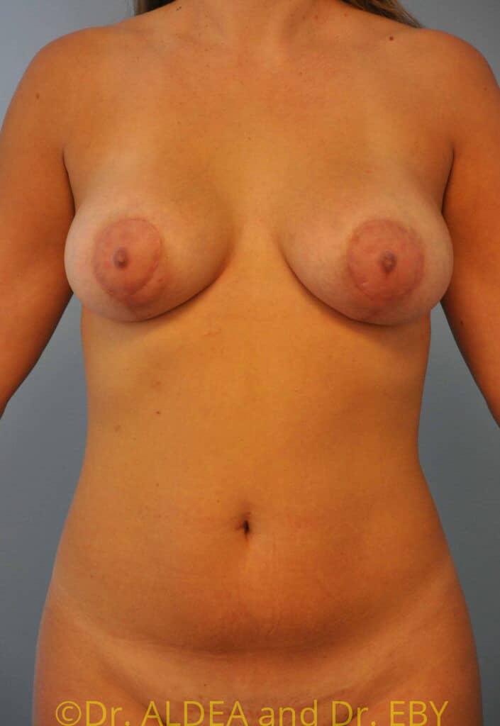 After Image: Breast Augmentation w/ Lift #264 - front
