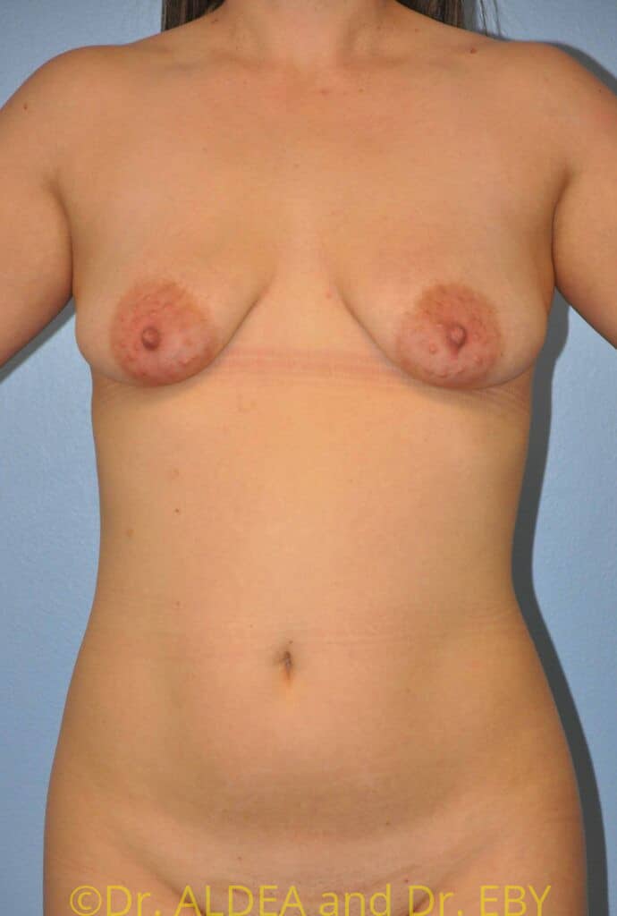 Before Image: Breast Augmentation w/ Lift #264 - front