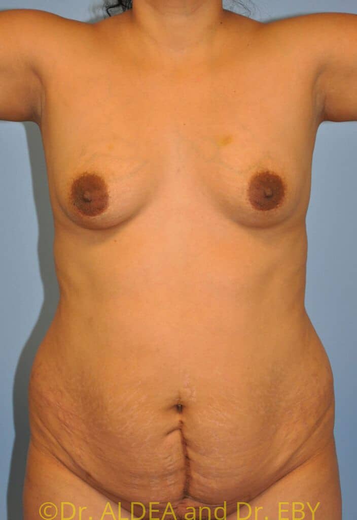 Before Image: Tummy Tuck #630 - front