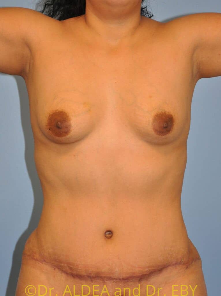 After Image: Tummy Tuck #630 - front