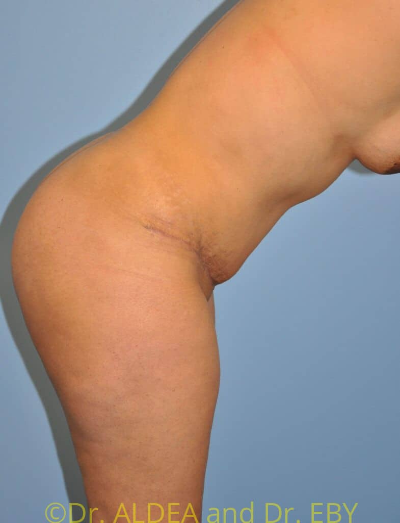 After Image: Tummy Tuck #630 - right-side