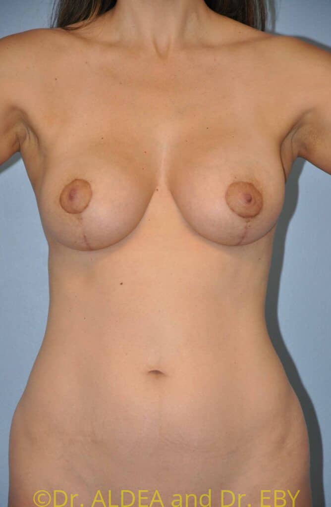 After Image: Breast Augmentation w/ Lift #913 - front