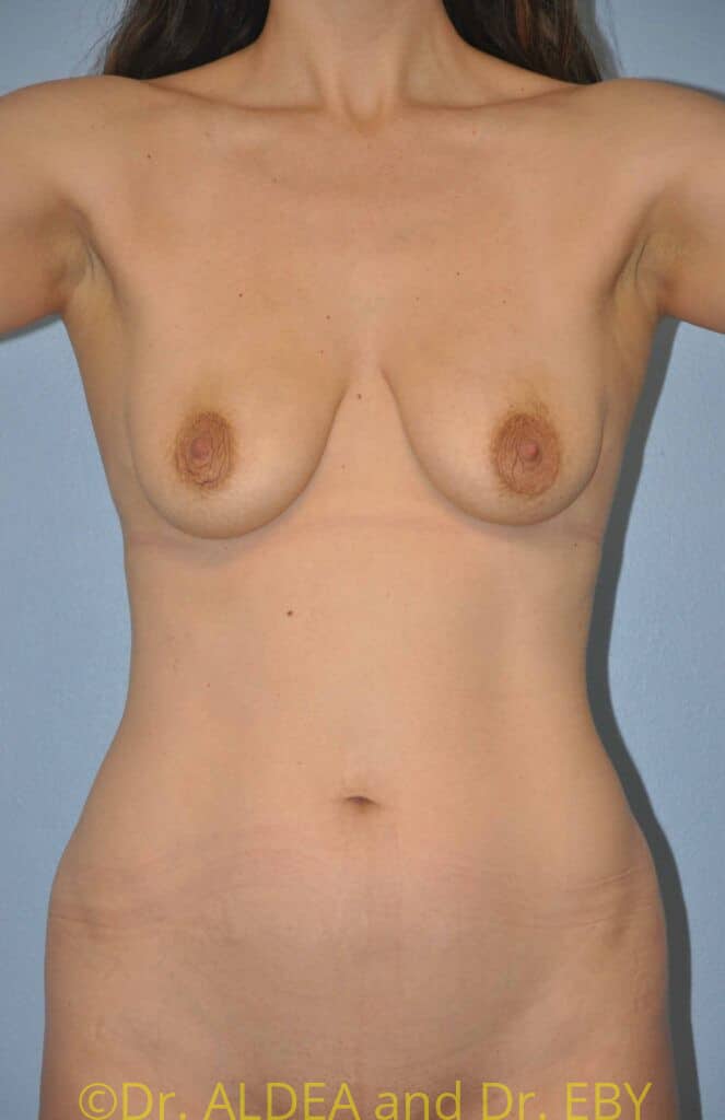 Before Image: Breast Augmentation w/ Lift #913 - front