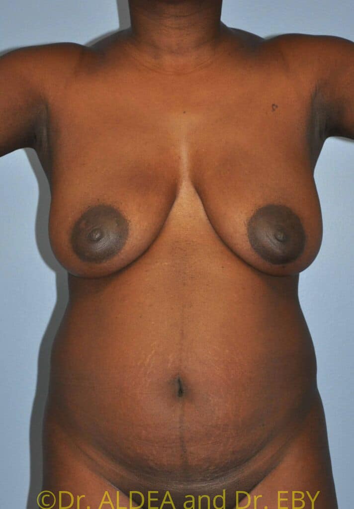 Before Image: Tummy Tuck #432 - front