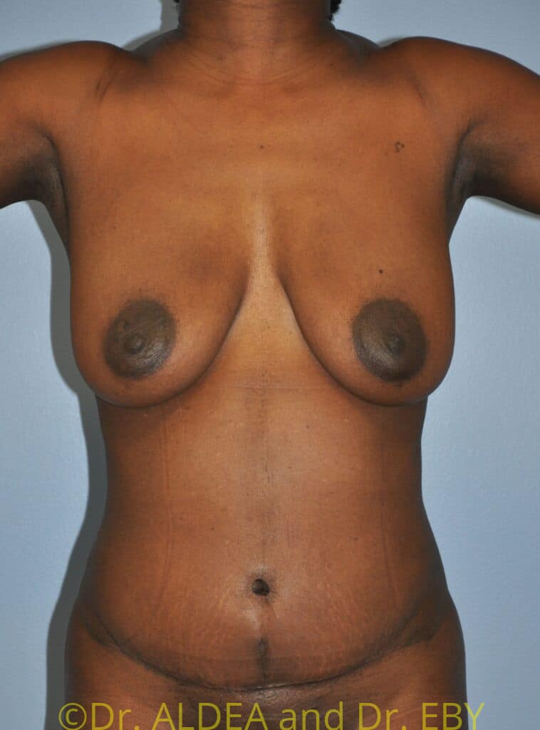 After Image: Tummy Tuck #432 - front