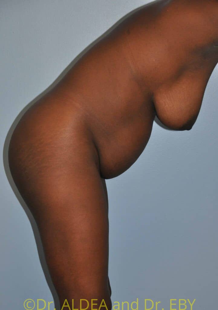 Before Image: Tummy Tuck #432 - other