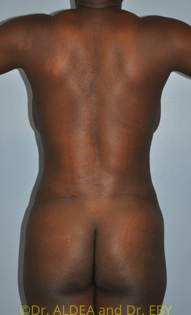After Image: Tummy Tuck #432 - back