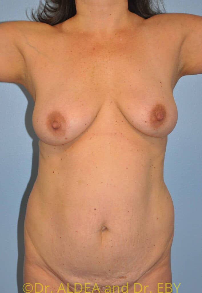 Before Image: Tummy Tuck #554 - front