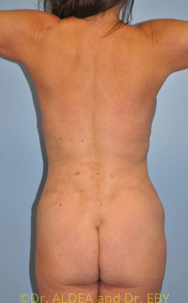 After Image: Tummy Tuck #554 - back