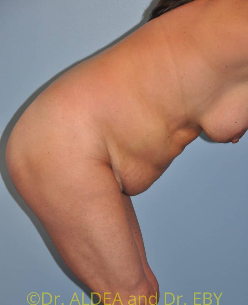 Before Image: Tummy Tuck #554 - other