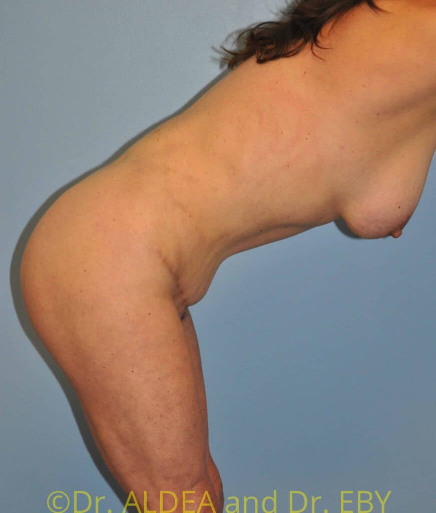 After Image: Tummy Tuck #554 - other