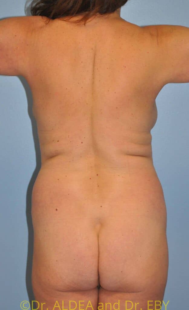 Before Image: Tummy Tuck #554 - back