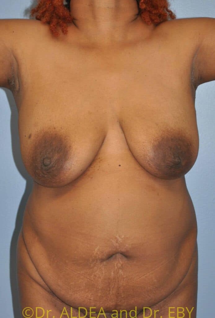 Before Image: Tummy Tuck #482 - front