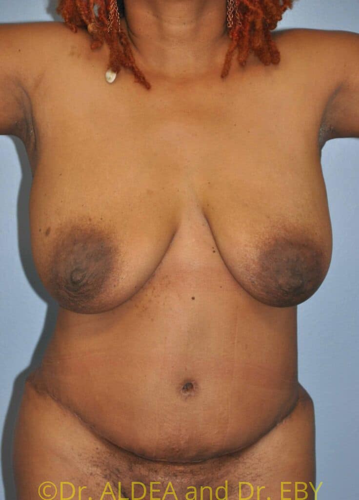 After Image: Tummy Tuck #482 - front