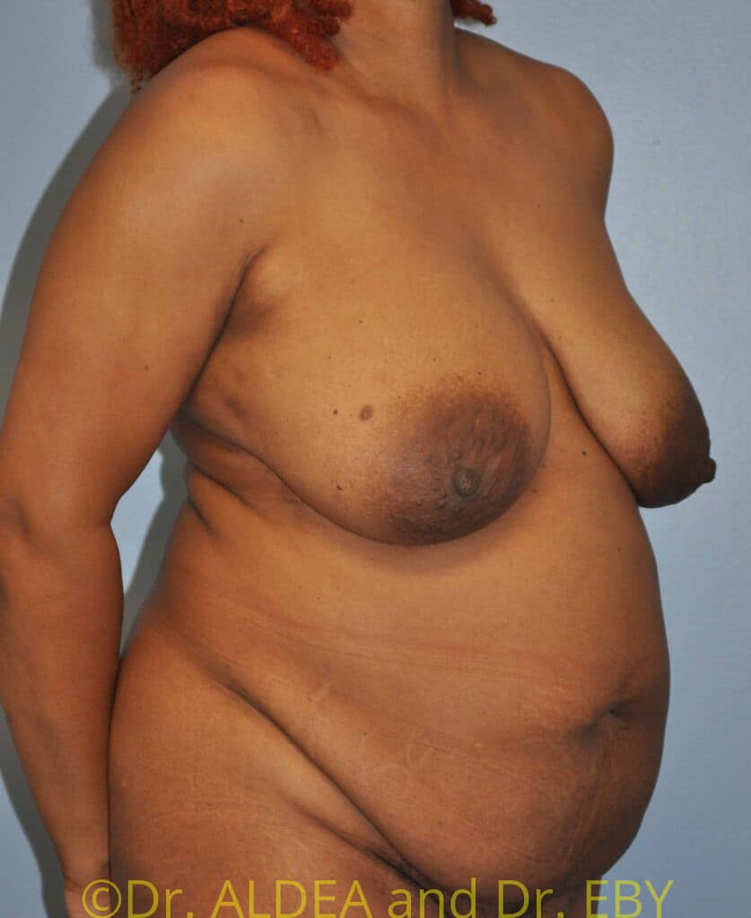 Before Image: Tummy Tuck #482 - right-front-oblique