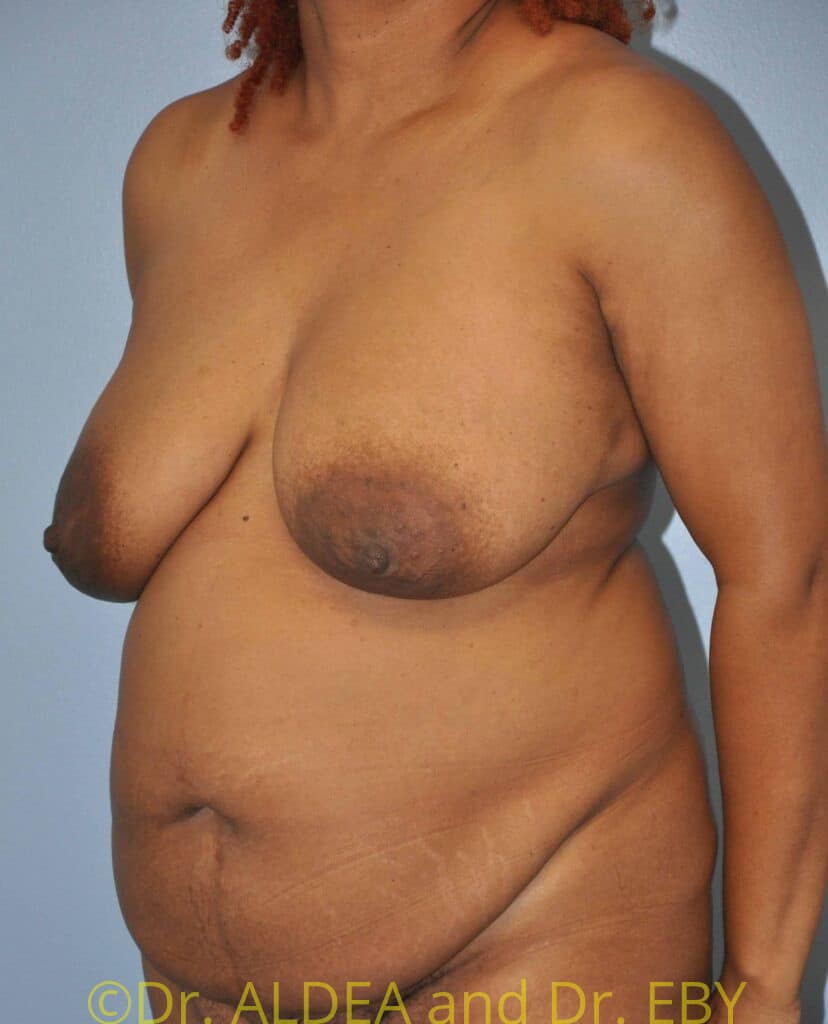 Before Image: Tummy Tuck #482 - left-front-oblique