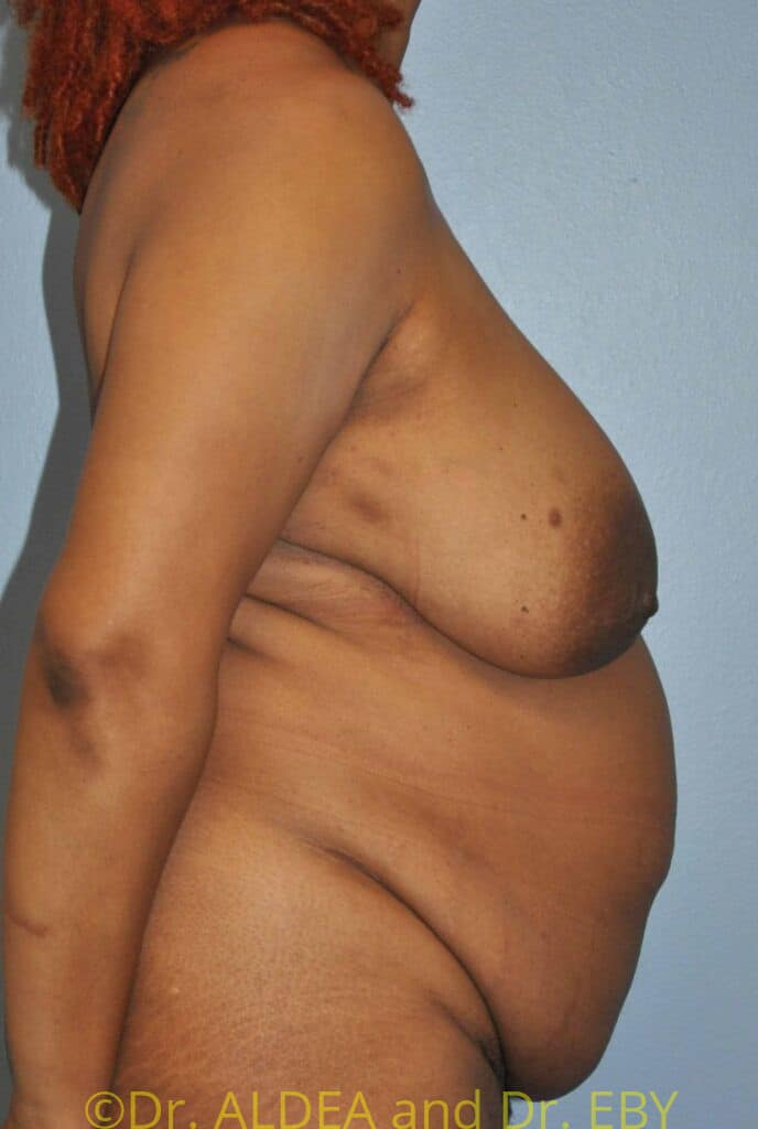 Before Image: Tummy Tuck #482 - right-side