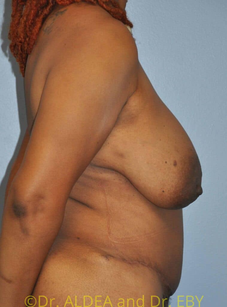 After Image: Tummy Tuck #482 - right-side
