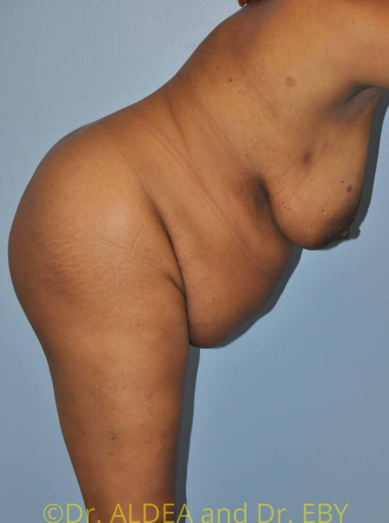 Before Image: Tummy Tuck #482 - right-side