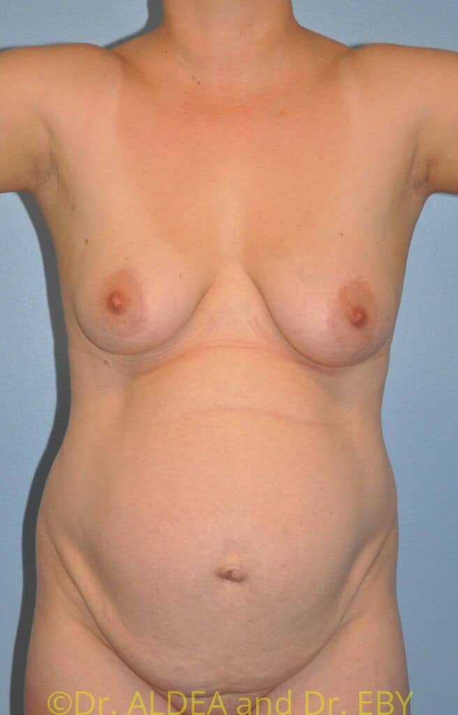 Before Image: Tummy Tuck #538 - front
