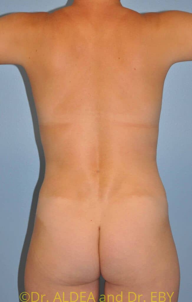 After Image: Tummy Tuck #538 - back