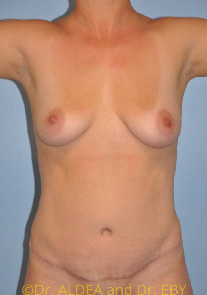 After Image: Tummy Tuck #538 - front