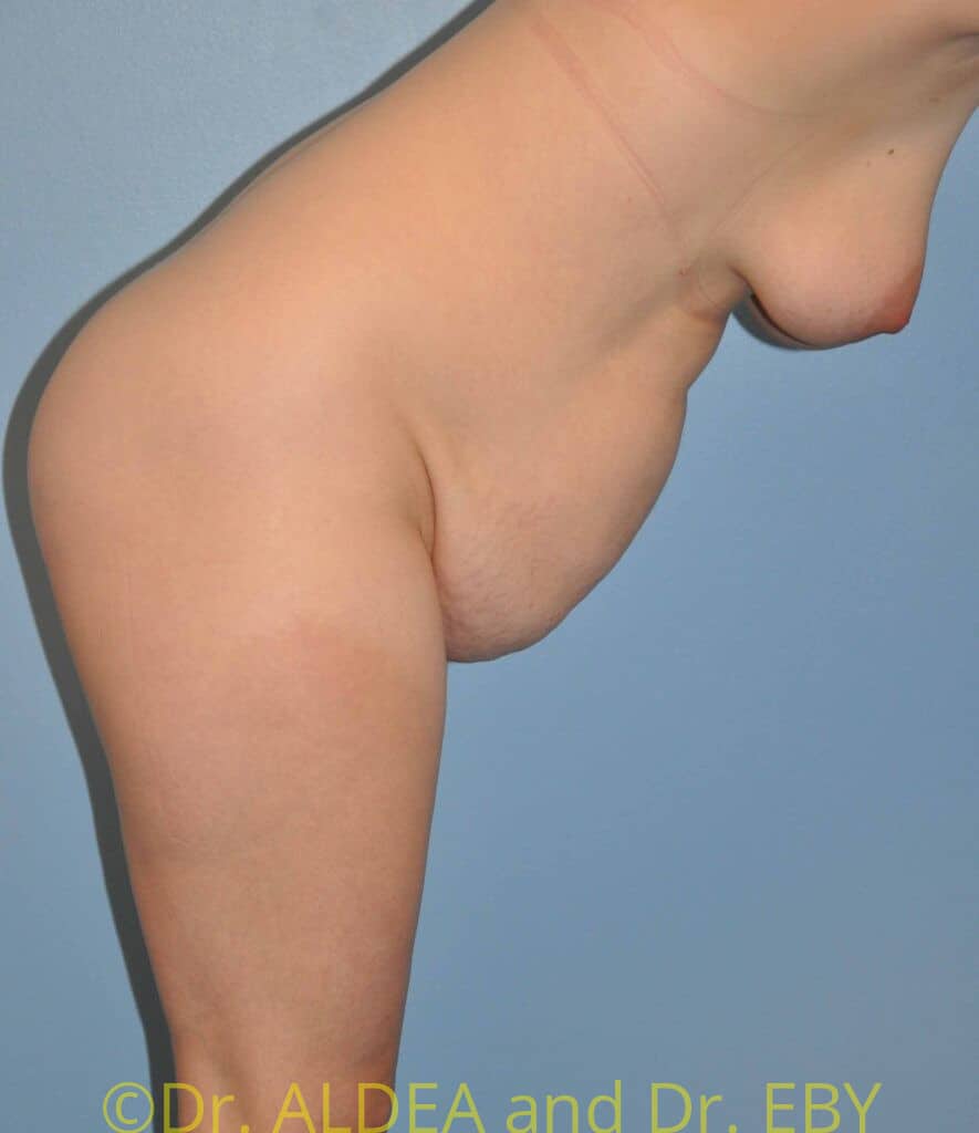Before Image: Tummy Tuck #538 - right-side