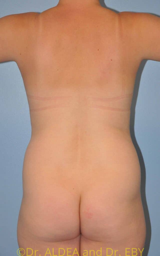 Before Image: Tummy Tuck #538 - back