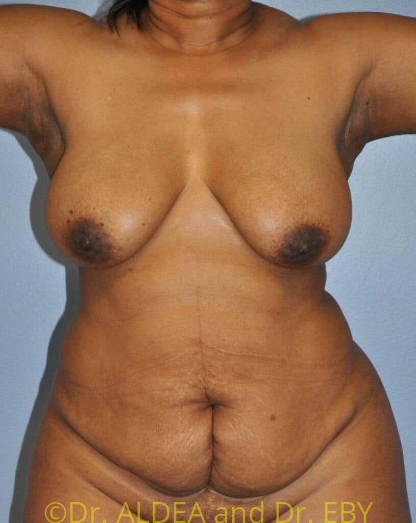 Before Image: Tummy Tuck #750 - front