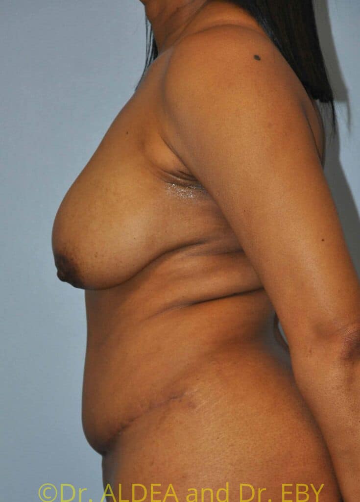 After Image: Tummy Tuck #750 - left-side
