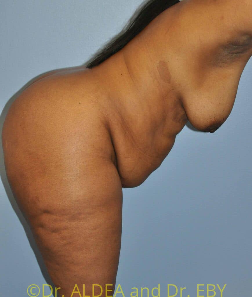 Before Image: Tummy Tuck #750 - other