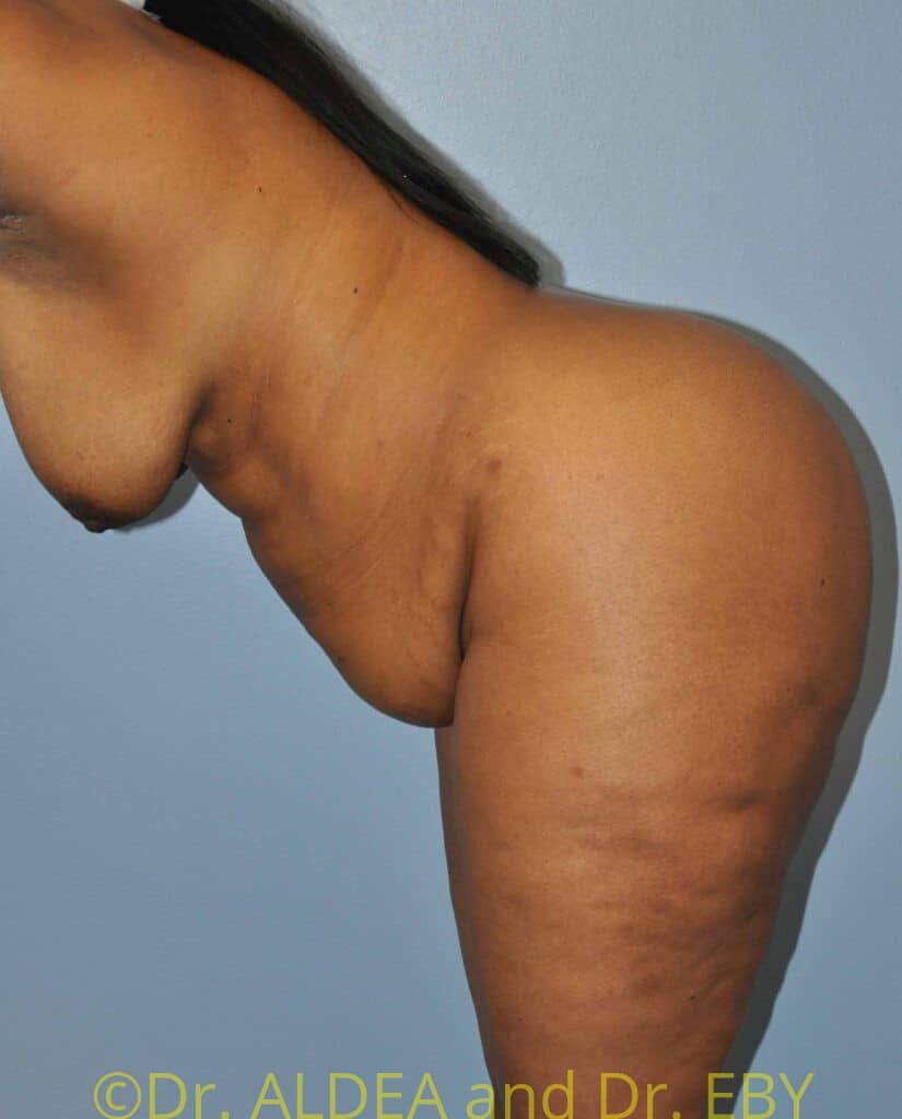 Before Image: Tummy Tuck #750 - other