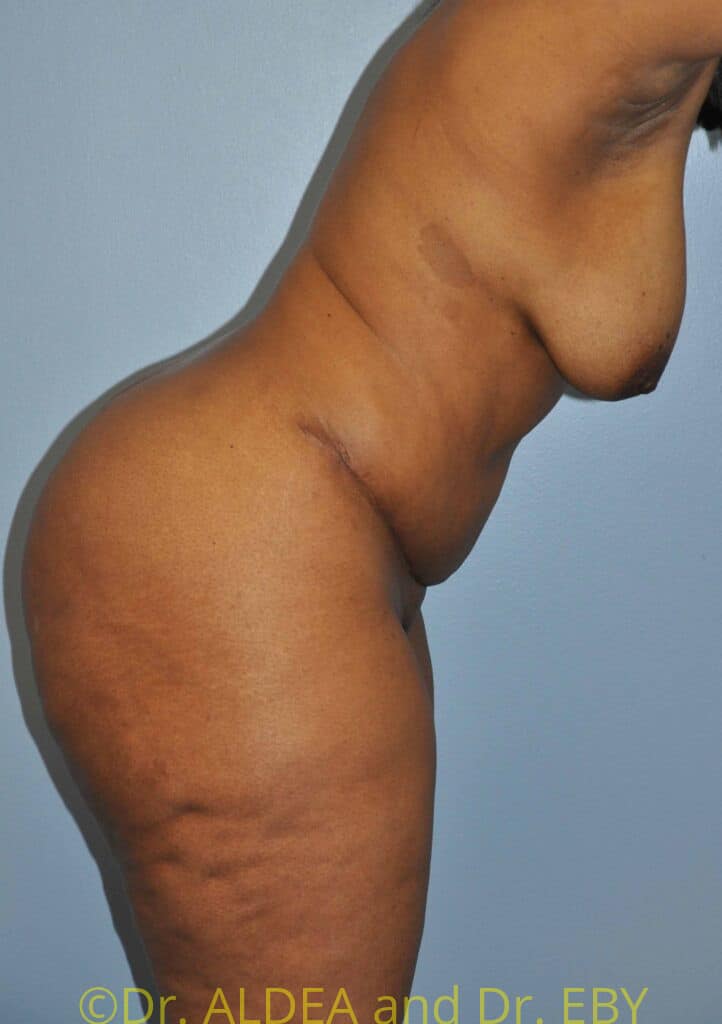 After Image: Tummy Tuck #750 - other