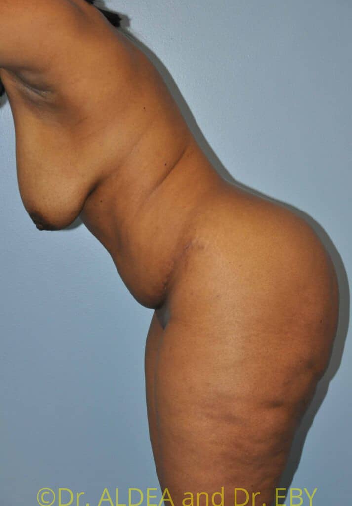 After Image: Tummy Tuck #750 - other