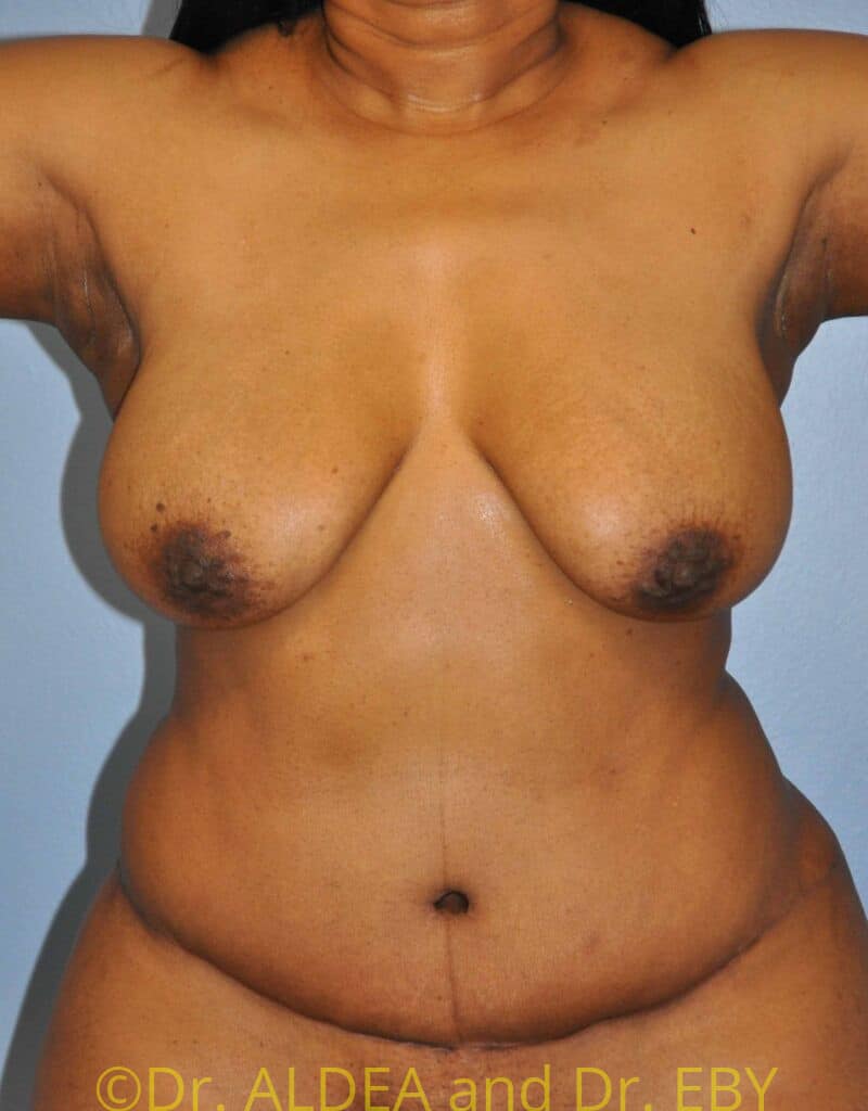 After Image: Tummy Tuck #750 - front