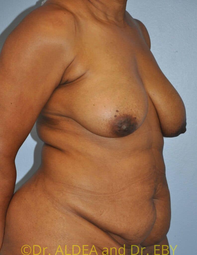 Before Image: Tummy Tuck #750 - right-front-oblique