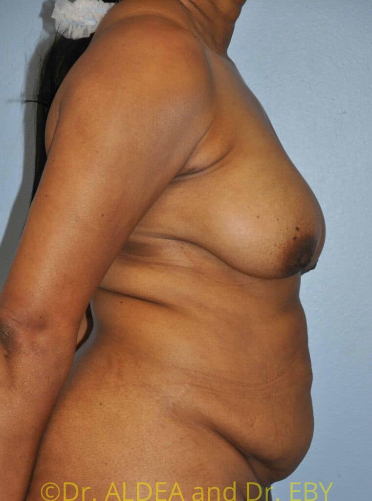 Before Image: Tummy Tuck #750 - right-side