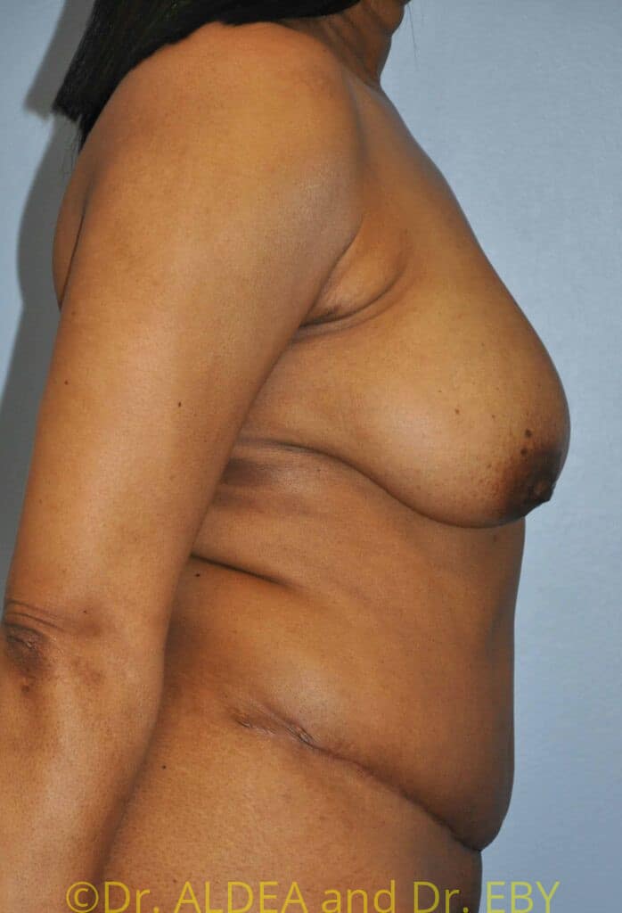 After Image: Tummy Tuck #750 - right-side