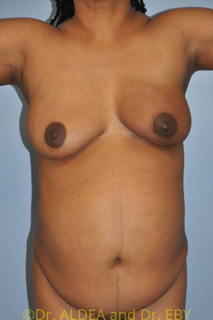 Before Image: Tummy Tuck #370 - front