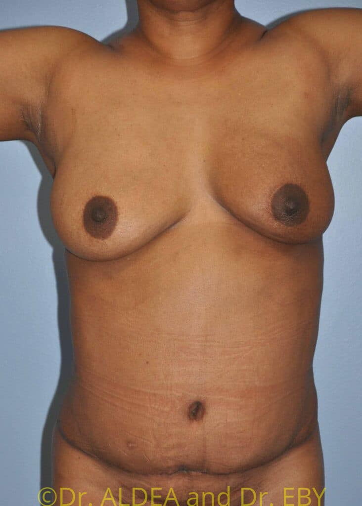 After Image: Tummy Tuck #370 - front