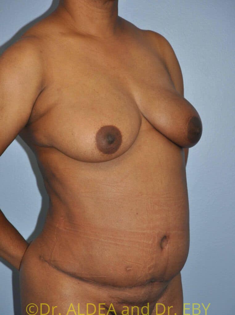 After Image: Tummy Tuck #370 - right-front-oblique