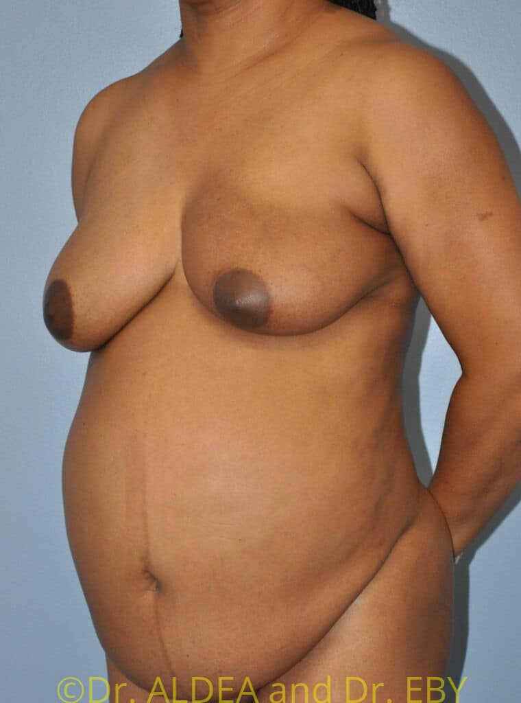 Before Image: Tummy Tuck #370 - left-front-oblique