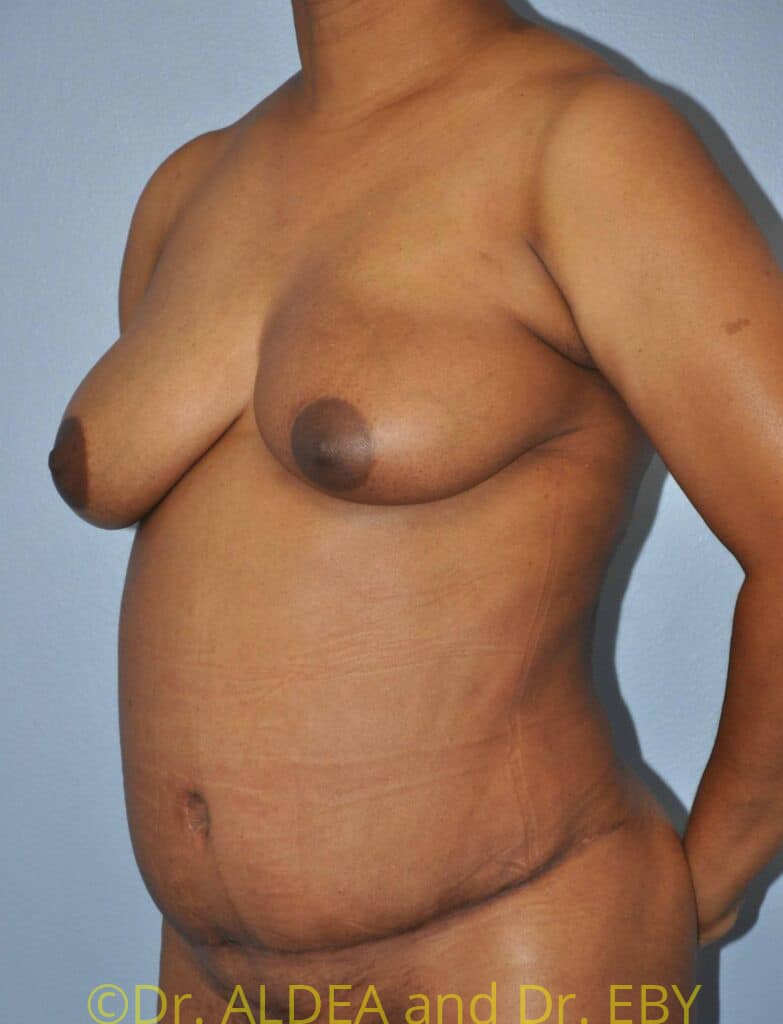 After Image: Tummy Tuck #370 - left-front-oblique