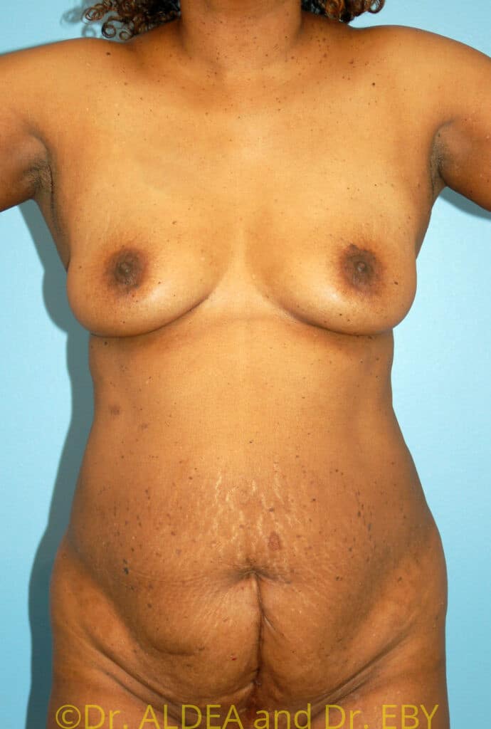 Before Image: Tummy Tuck #548 - front
