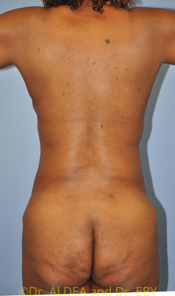 After Image: Tummy Tuck #548 - back