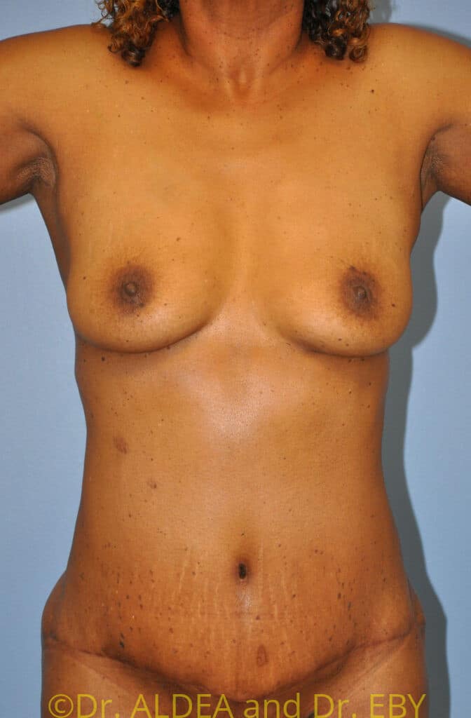 After Image: Tummy Tuck #548 - front
